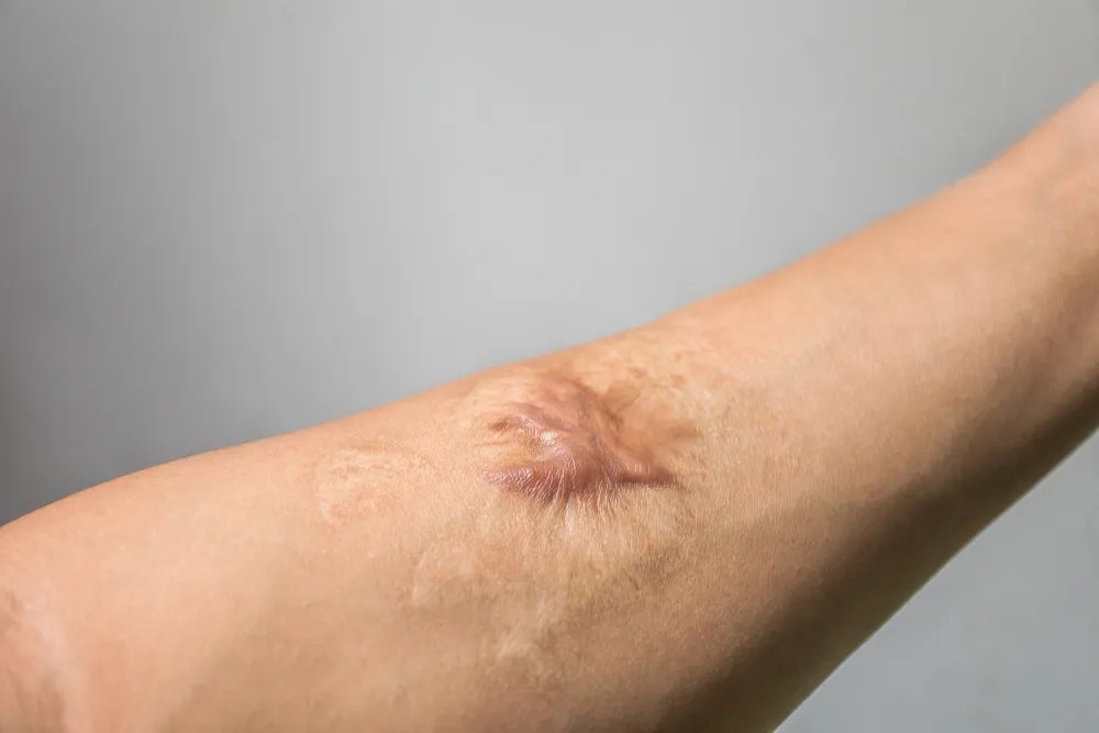 Jerawat dapat meninggalkan bekas merah atau cokelat di kulit yang . Skar Hipertrofi Dan Keloid Adalah Bekas Luka Yang Timbul Apa Bedanya