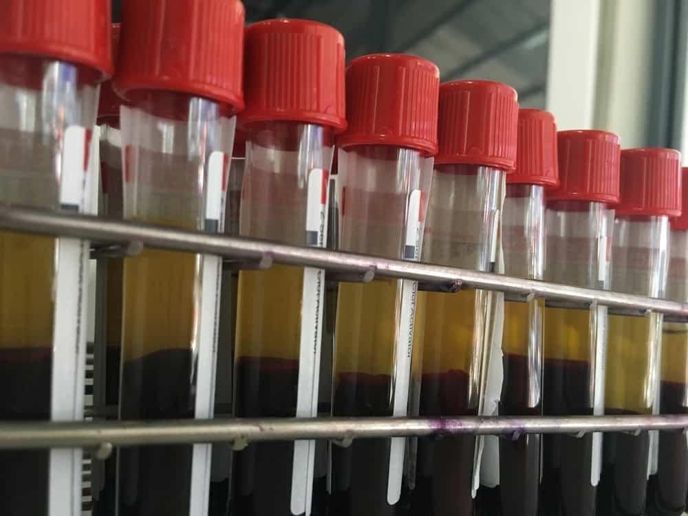 Larutan albumin yang dibuat dari darah, mengandung protein dan elektrolit tetapi. Mengenal Plasma Darah Dan Fungsi Pentingnya Untuk Tubuh