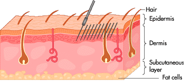 Covers liner, shader, flat, weaved magnum, stacked and round magnum tattoo needles. What is a Tattoo? - How Tattoo Removal Works | HowStuffWorks