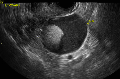 Dermoid cyst ultrasound