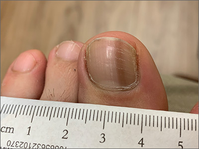 Dark toenail line