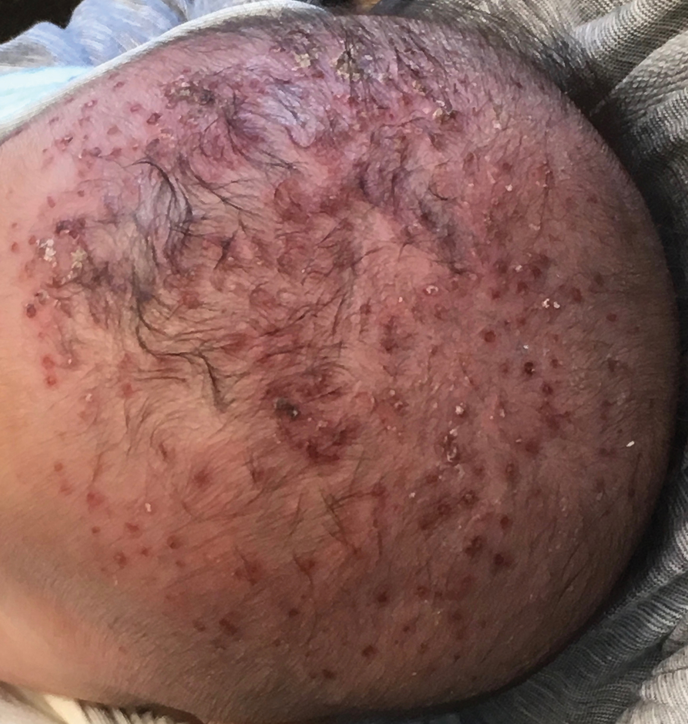 They can also form elsewhere on the face, especially around the chin and below the nose, or on the&nbsp;. Seborrhea Herpeticum Cutaneous Herpes Simplex Virus Infection Within Infantile Seborrheic Dermatitis Mdedge Dermatology