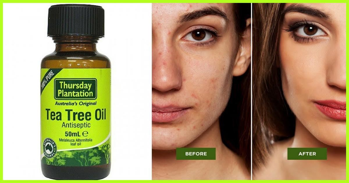 10 Reasons To Put Tea Tree Oil On Your Skin Beat Acne Eczema More