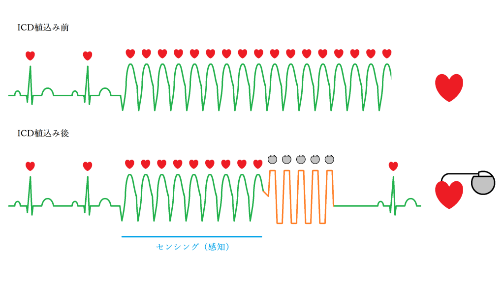 植込み型除細動器はどのように機能しますか?