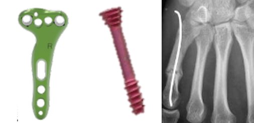 Plaque et vis d'ostéosynthèse, à côté d'une radiographie où le matériel est en place.