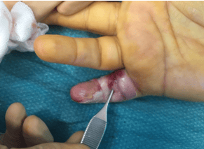 Photographie d'un doigt lors d'une incision chirurgicale, sur champ opératoire.