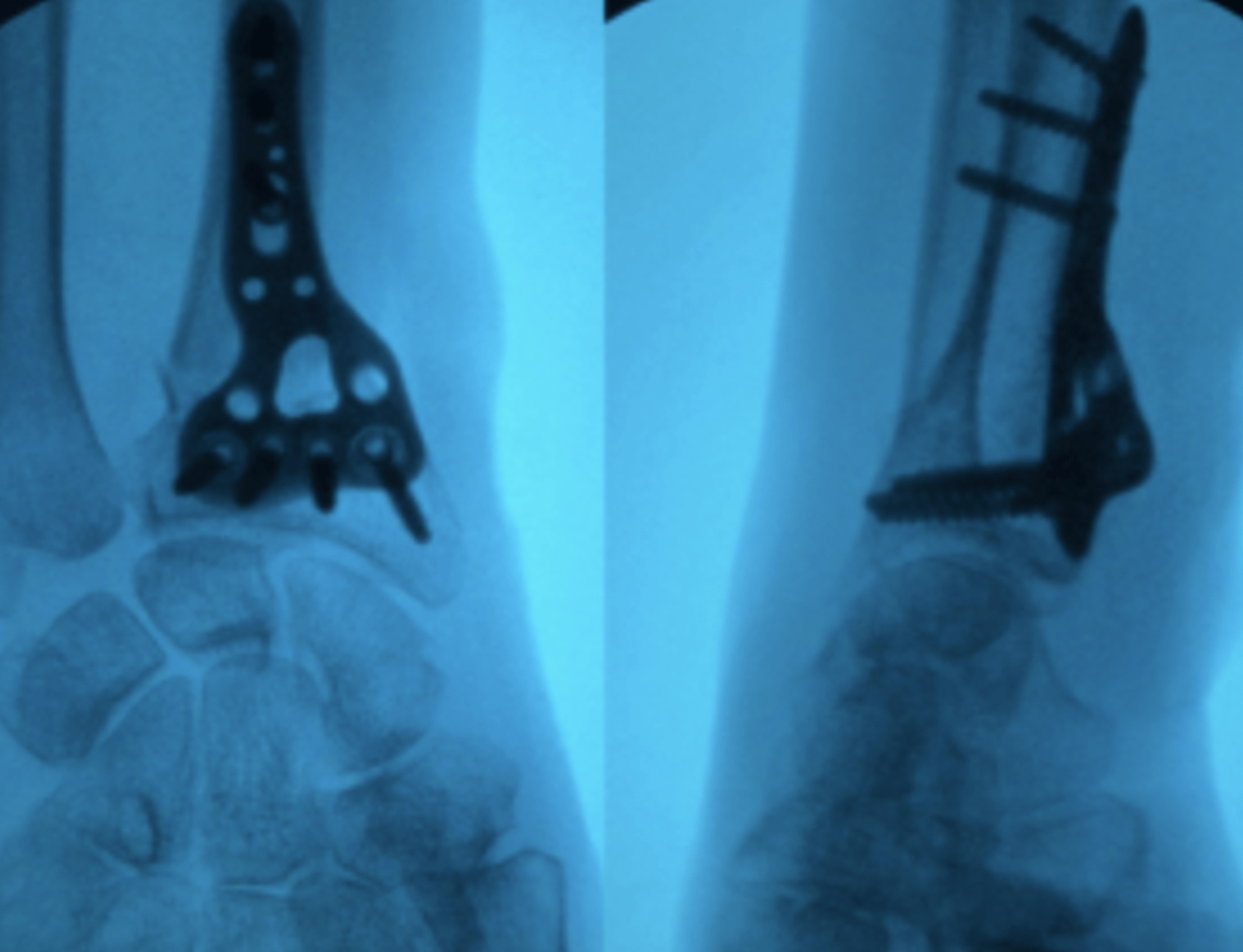 Deux radiographies de poignet après pose d'une plaque vissée sur le radius.