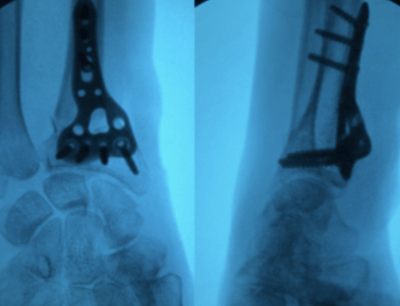 Deux radiographies de poignet après pose d'une plaque vissée sur le radius.