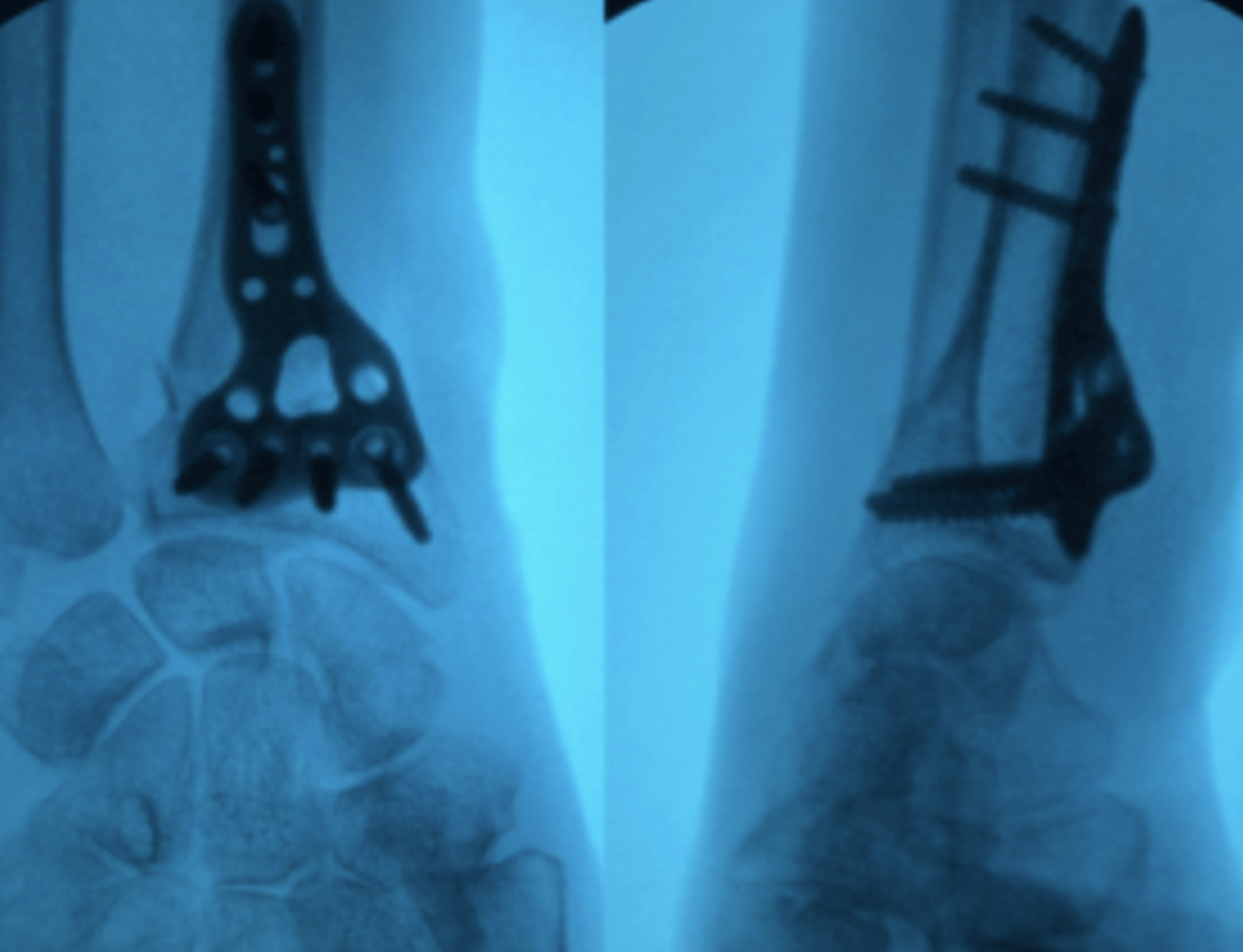 Deux radiographies de poignet après pose d'une plaque vissée sur le radius.