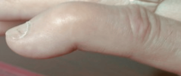 Photographie d'un doigt dont la dernière phalange reste fléchie.