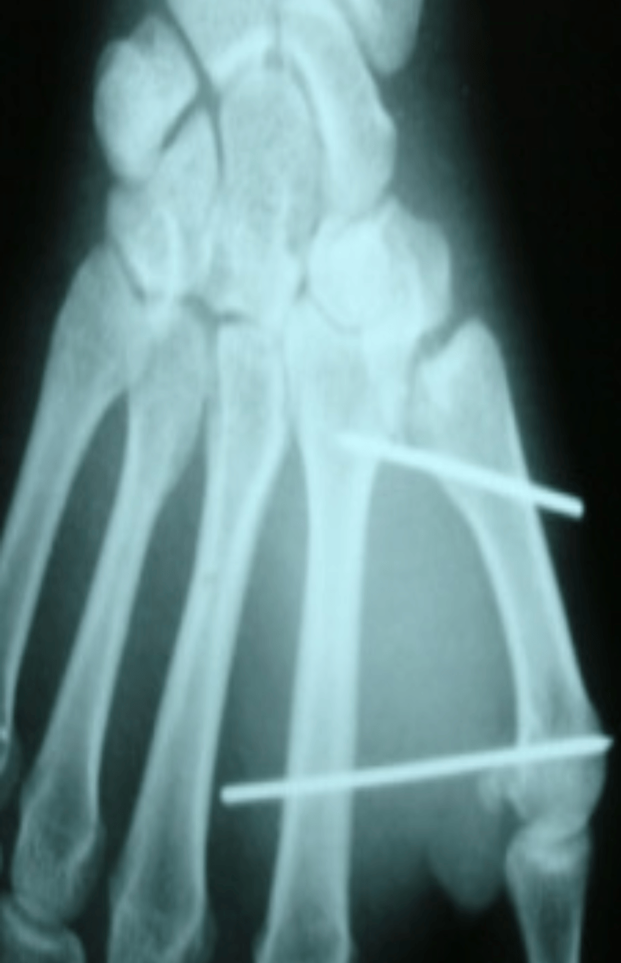 Radiographie de la main, deux broches maintenant la base du premier métacarpien.