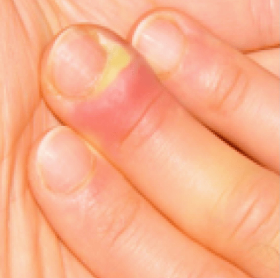 Photographie d'un doigt dont le pourtour de l'ongle est rouge et gonflé.