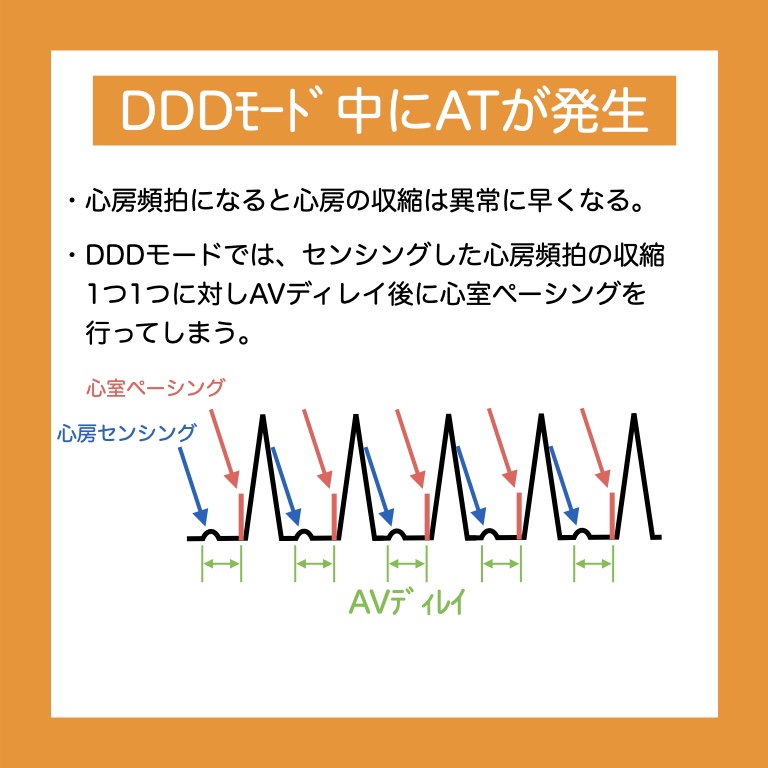 pacemakermodeswitch2 臨床工学技士 岡井さんの集中治療ブログ
