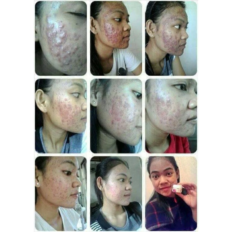 Tidak cukup tidur meningkatkan produksi hormon androgen yang dapat memicu timbulnya jerawat . 1 Paket Krim Acne Jerawat Drw Skinscare Penghilang Bekas Jerawat Shopee Indonesia