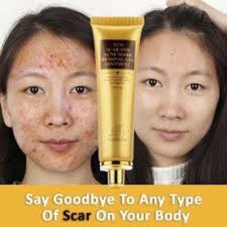 Vitacid 0.05% cream 20 gram · vitacid 0.05% cream 20 gram. Jual Lanbena Krim Penghilang Bekas Jerawat Noda Komedo Hitam Luka Indonesia Shopee Indonesia