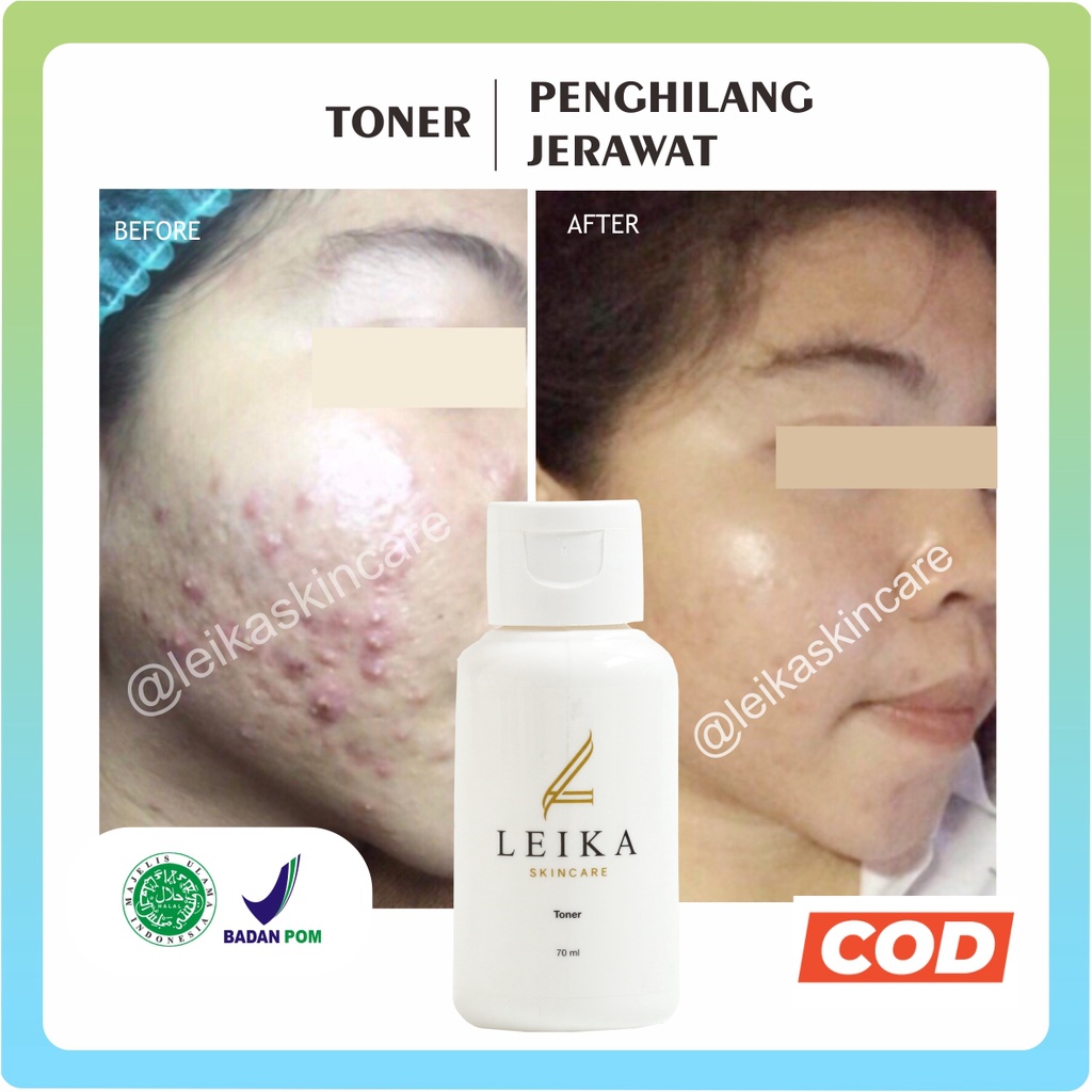 Mineral botanica acne care toner · 3. Harga Toner Bpom Untuk Menghilangkan Bekas Jerawat Terbaru Maret 2022 Biggo Indonesia