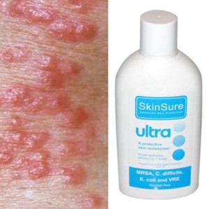 Obat Segala Penyakit Kulit Eksim Dermatitis Scabies Herpes Alergi