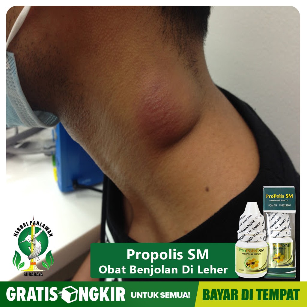 Di antara berbagai jenis tb di luar paru ini, limfadenitis tuberkulosis atau tbc kelenjar memiliki persentase terbesar di antara berbagai jenis . Jual Obat Benjolan Di Leher Kelenjar Getah Bening Bengkak Tbc Kelenjar Propolis Sm Bisa Cod Free Ongkir Indonesia Shopee Indonesia
