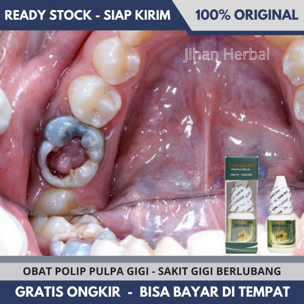 Simak obat dan cara cepat mengobati gusi bernanah! Jual Obat Polip Gigi Polip Pulpa Gigi Polip Gusi Gusi Bengkak Nyeri Gusi Gusi Bernanah Gusi Berdarah Obat Sakit Gigi Anak Sakit Gigi Berlubang Gigi Ngilu Gigi Goyang Gigi Keropos Gigi Kuning