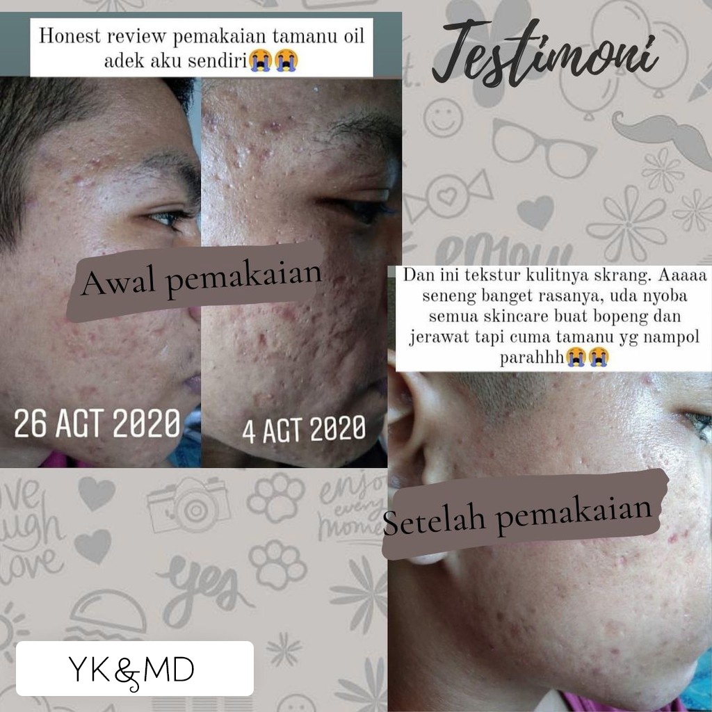 Kalau kalian mau beli tanamu tanami, bisa beli di sini, hati hati barang palsu ya, harganya emang segitu satu indonesia. Jual Tamanu Oil Original 30ml Indonesia Shopee Indonesia