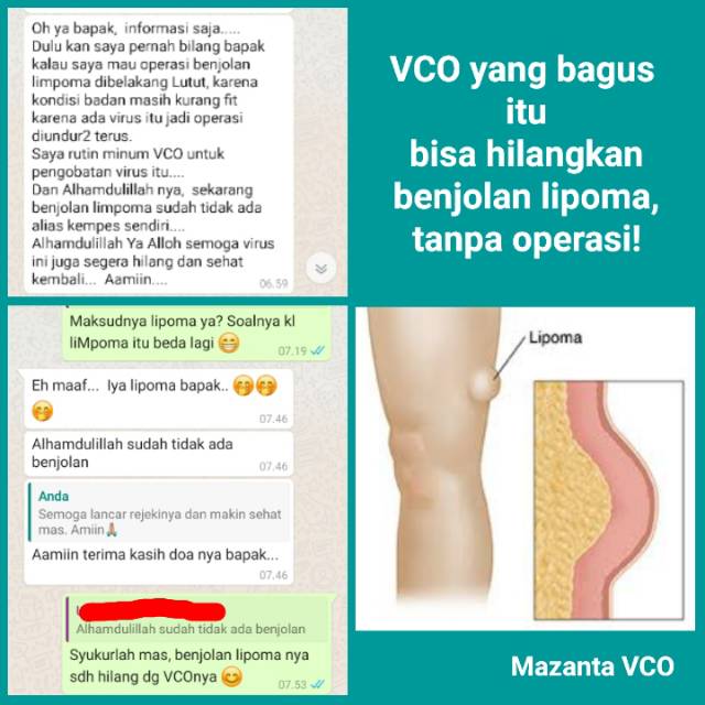 Mazanta VCO - Obat Alami Benjolan Lipoma Tanpa Operasi untuk Terapi 10 Hari  | Shopee Indonesia