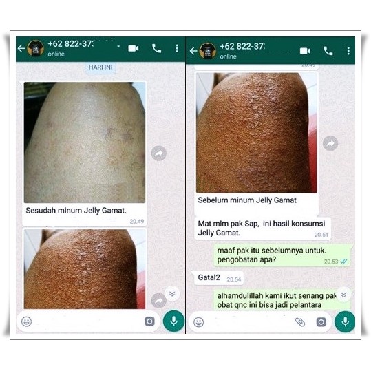 Obat Keratosis Pilaris Herbal Obat Penyakit Kulit Ayam Aman