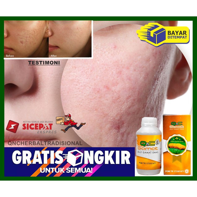 Innisfree bija trouble lotion · 3. Obat Oles Penghilang Bopeng Bekas Jerawat Flek Hitam Di Wajah Bekas Luka Koreng Cacar Air Komedo Shopee Indonesia