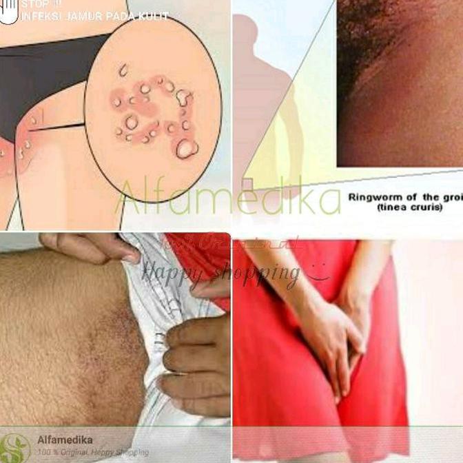 Terlariss Obat Gatal 1 Jamur Pada Selangkangan Selakangan 2 Panu 3