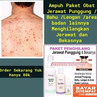 Sifat asamnya menjadikannya solusi yang sangat baik untuk menghilangkan jerawat. Paket Obat Jerawat Di Punggung Dada Dan Badan Penghilang Jerawat Punggung Obat Jerawat Punggung Shopee Indonesia
