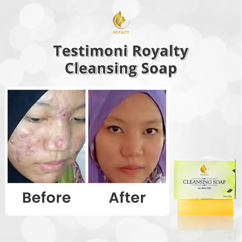 Royalty cleansing soap adalah sabun wajah yang diformulasikan untuk perawatan kecantikan wajah. Jual Sabun Penghilang Jerawat Cepat Secara Alami Mencerahkan Wajah Kusam Ampuh Royalty Brightening Soap Indonesia Shopee Indonesia