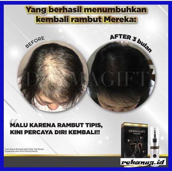 Your browser can't play this video. Jual Riah Mures Dermagift Paket Platinum Serum Untuk Rambut Rontok Bpom Obat Rontok Ori Aseli Indonesia Shopee Indonesia
