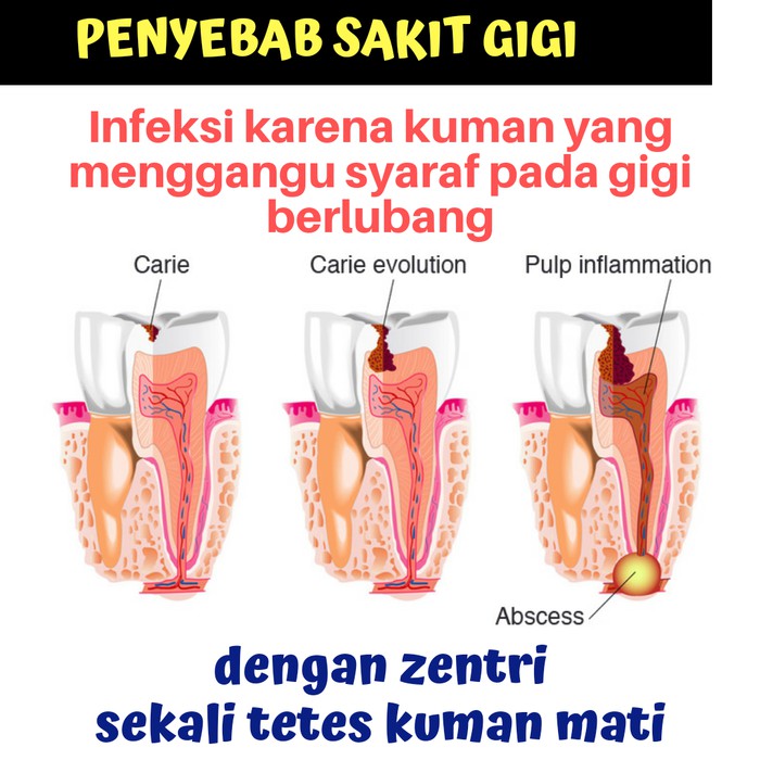 Obat Sakit Gigi Ampuh Manjur 3 Menit Sembuh Shopee Indonesia