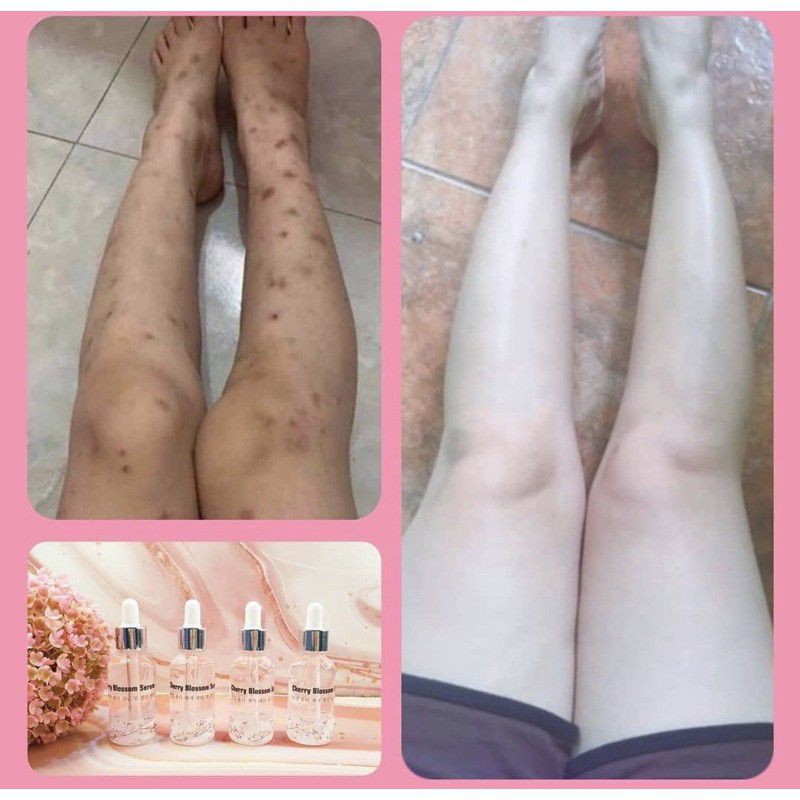 Whitening brightening pemutih serum cream scrub penghilang bekas jerawat wajah badan . Jual Serum Korea Penghilang Flek Bekas Luka Koreng Kulit Jadi Mulus Halus Cerah Cherry Blossom Seaso Indonesia Shopee Indonesia