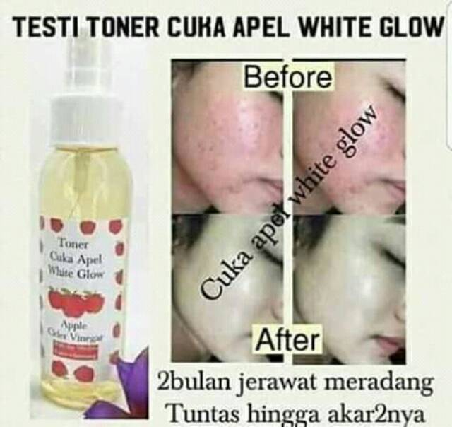 Guys aku mau sharing hasil aku pakai cuka apel selama sebulan. Jual Toner Cuka Apel White Glow Toner Cuka Apel Indonesia Shopee Indonesia