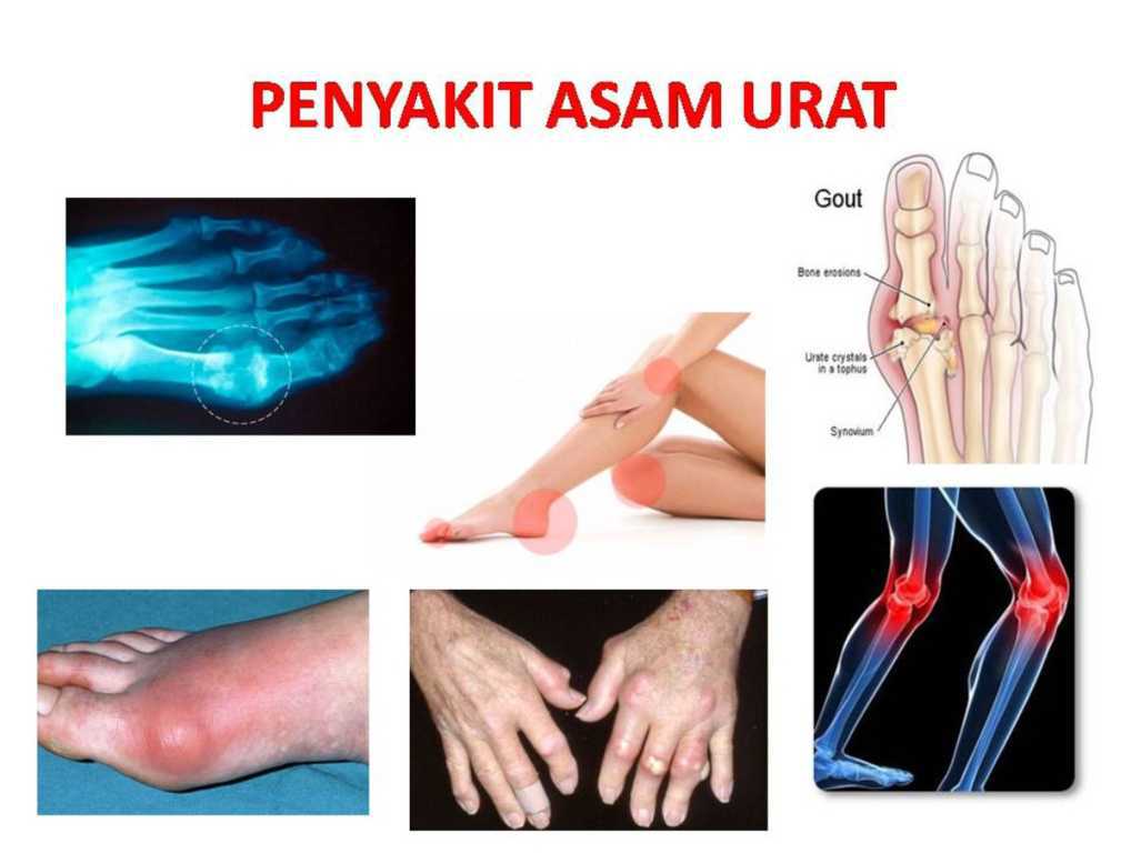 Pada dasarnya, semua sendi manusia berisiko terkena asam urat. Obat Asam Urat Herbal Herbal Asam Urat Obat Nyeri Sendi Obat Lutut Bengkak Shopee Indonesia