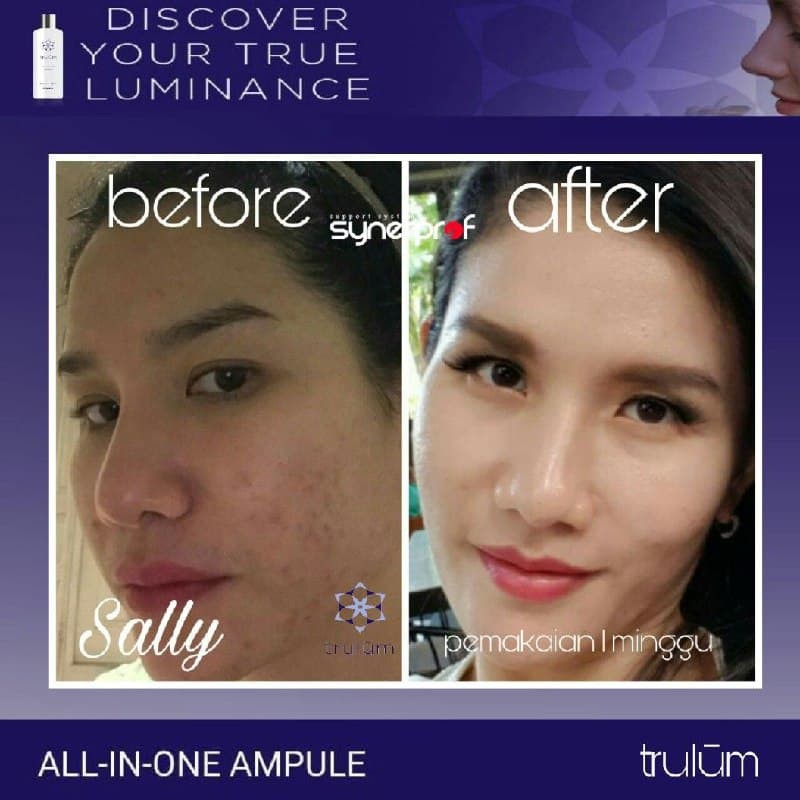 Acne warrior merupakan obat jerawat yang efektif untuk menyembuhkan jerawat, namun dengan efek samping yang lebih minim dibandingkan salep . Jual Bebas Jerawat Tanpa Bahan Kimia Trulum 15 Ml Obat Jerawat Flek Hitam Indonesia Shopee Indonesia