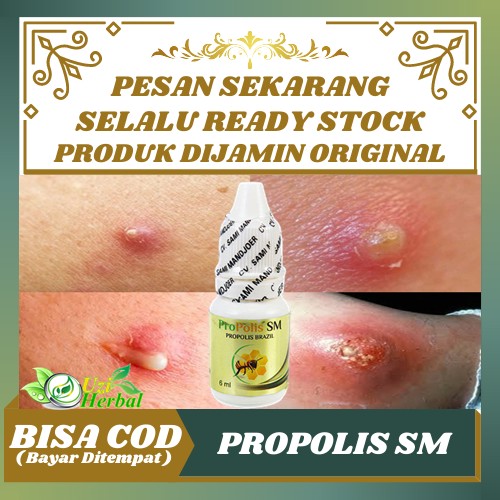 Munculnya bisul di kemaluan terkadang bisa . Jual Populer Obat Bisul Kelamin Bisul Di Kemaluan Pria Dan Wanita Herbal Propolis Indonesia Shopee Indonesia