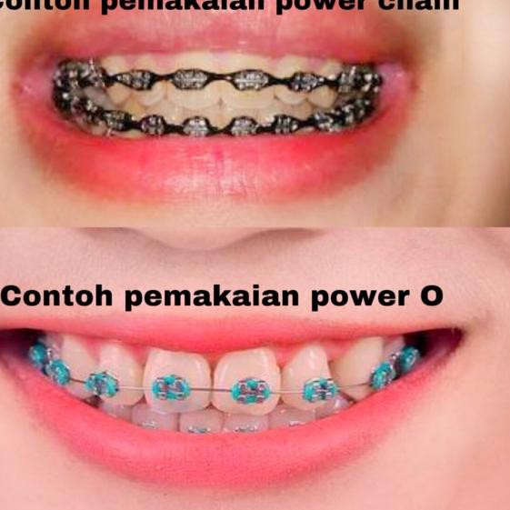 Yuk Bahas Warna Karet Behel Yang Lagi Trend 2019 [Terlengkap] 