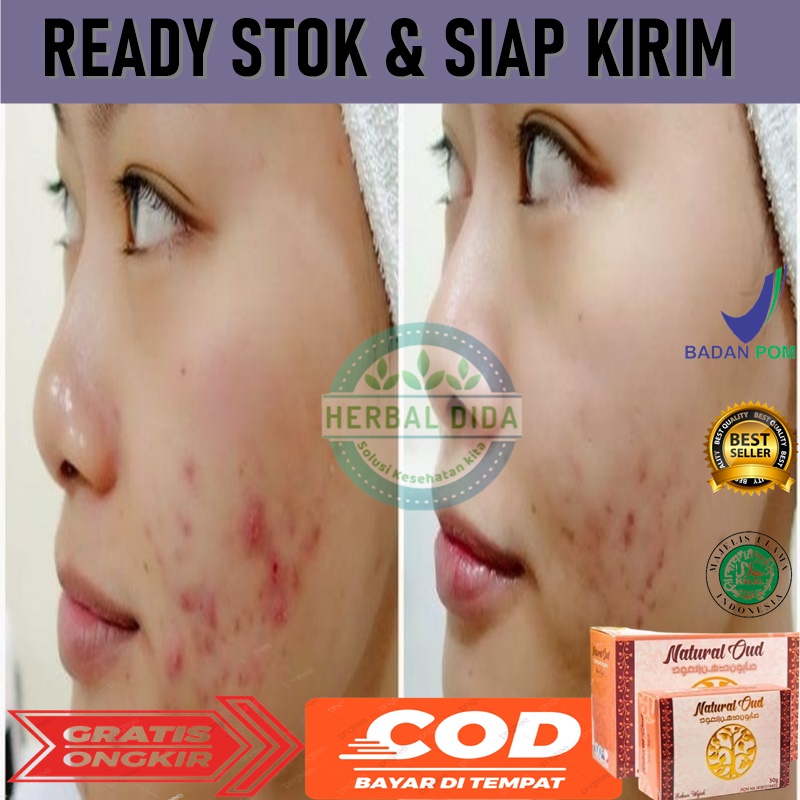 Cara menghilangkan lubang bekas jerawat dengan ramuan ini sangat mudah, yaitu ambil datu sendok makan madu, kemudian campurkan dengan satu . Harga Obat Bopeng Bekas Jerawat Wanita Terbaru April 2022 Biggo Indonesia