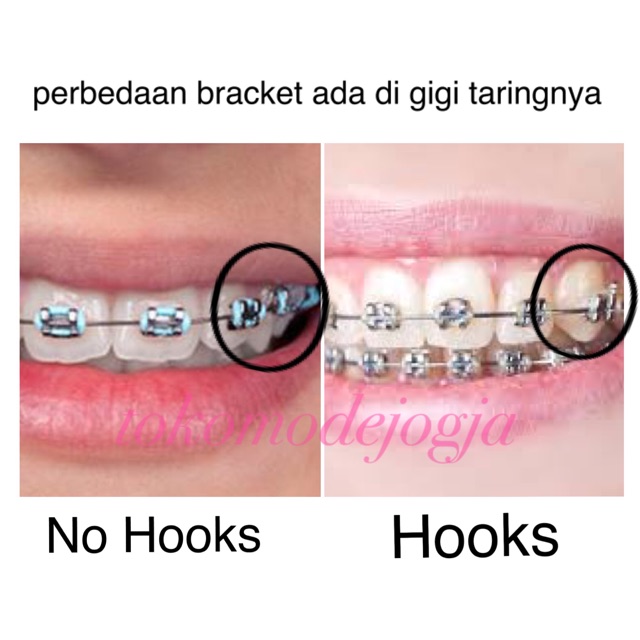 Setelah behel dilepas dan gigi dibersihkan dari lem, dokter biasanya akan membuat cetakan untuk penahan. Murah Paket Pasang Behel Permanen Metal Lengkap Lem Behel Mouthgate Penyangga Kawat Karet Hooks Shopee Indonesia