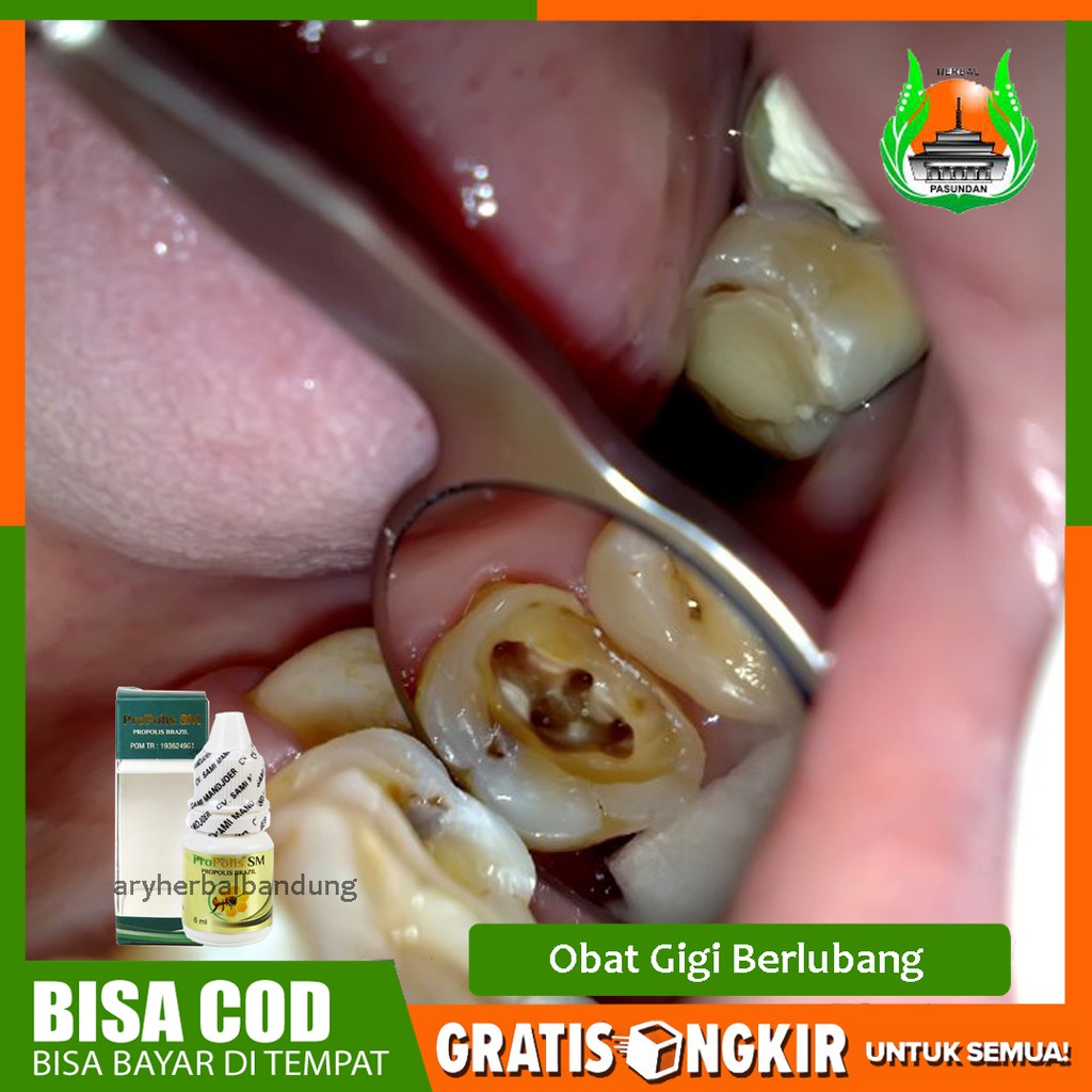 Sebelum kita lebih jauh membahas tentang obat sakit gigi berlubang alami yang aman untuk dikonsumsi, terlebih dahulu kita akan membahas . Obat Sakit Gigi Berlubang Obat Sakit Gigi Obat Gigi Berlubang Herbal Propolis Sm Asli 100 Shopee Indonesia