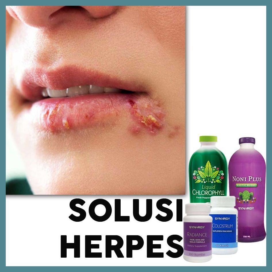 Obat Untuk Cacar Api Cacar Ular Herpes Untuk Pria Wanita