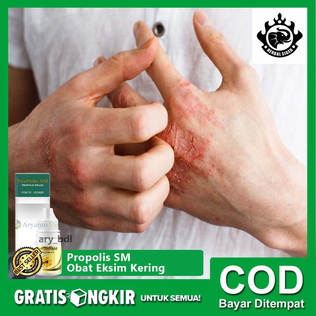Nah, itulah beberapa bahan alami untuk atasi kulit mengelupas yang wajib kita coba di rumah. Obat Eksim Kering Obat Gatal Eksim Herbal Terlaris Propolis Sm Original Legal Bpom Bisa Cod Shopee Indonesia