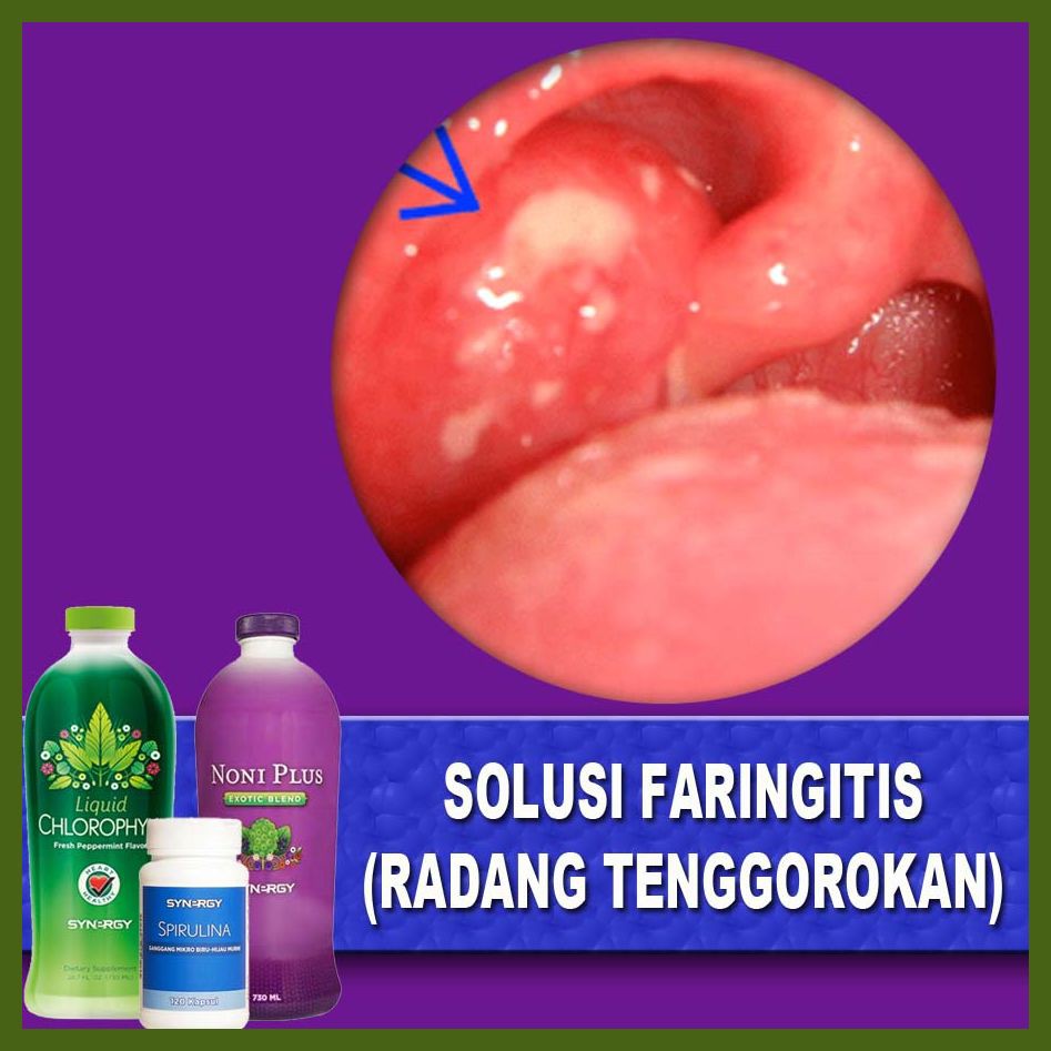Maxi Pack Obat Faringitis Tenggorokan Meradang Herbal Paling Laris