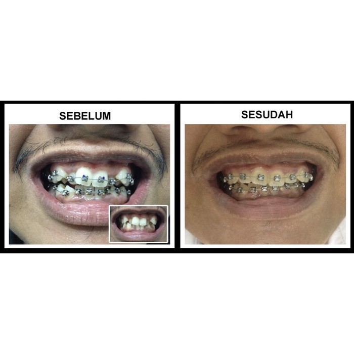 Termasuk klinik atau rumah sakit tempat kamu pasang behel pun akan berpengaruh terhadap biaya yang dikenakan. Paket Pemasangan Behel Oleh Dokter Gigi Ak723 Shopee Indonesia