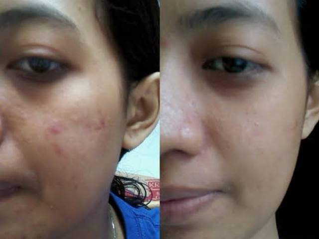 Manfaat bedak saripohatji tidak hanya bermanfaat untuk menghilangkan jerawat, . Masker Saripohatji Shopee Indonesia