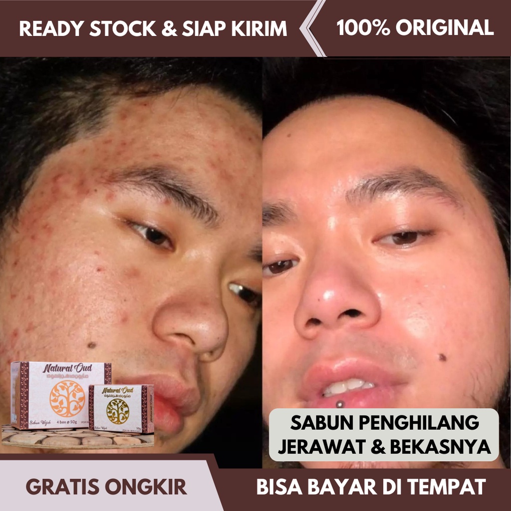 Face oil penghilang pembersih obat . Jual Obat Herbal Jerawat Penghilang Bekas Jerawat Pria Dan Wanita Penghilang Komedo Bopeng Jerawat Di Pipi Jerawat Punggung Jerawat Batu Milia Dan Bekas Jerawat Bukan