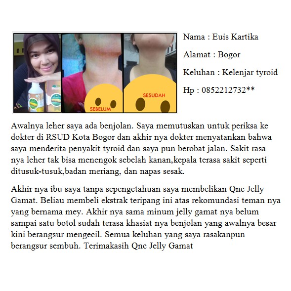 Obat Herbal Gondok Beracun Kelenjar Tiroid Benjolan Di Leher