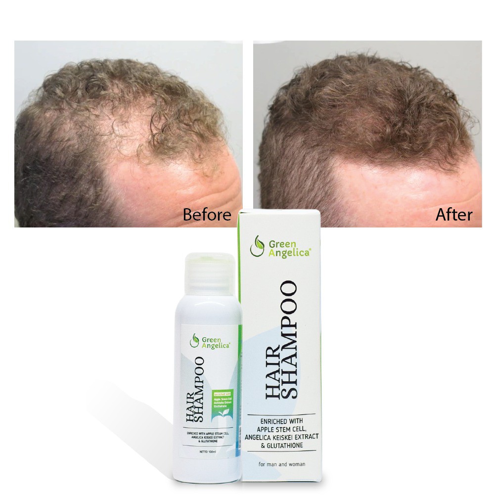 10 cara alami menghilangkan ketombe dan rambut rontok, mudah dan menyehatkan! Jual Green Angelica Shampo Anti Ketombe Mengatasi Rambut Rontok Parah Menghilangkan Ketombe Dengan Ampuh Indonesia Shopee Indonesia