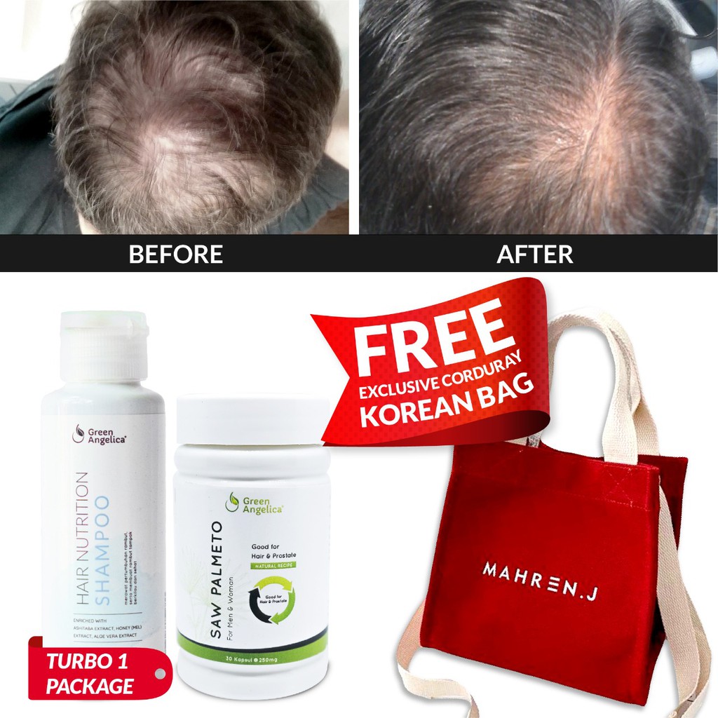 Jika kalian masih merasa bingung akan menggunakan hair tonic apa, berikut kami rekomendasikan 6 produk hair tonic yang bagus untuk kalian. Paket Tuerbo 1 Paket Suplemen Rambut Dan Menghilangkan Ketombe Cepat Secara Alami Dan Teruji Bpom Shopee Indonesia